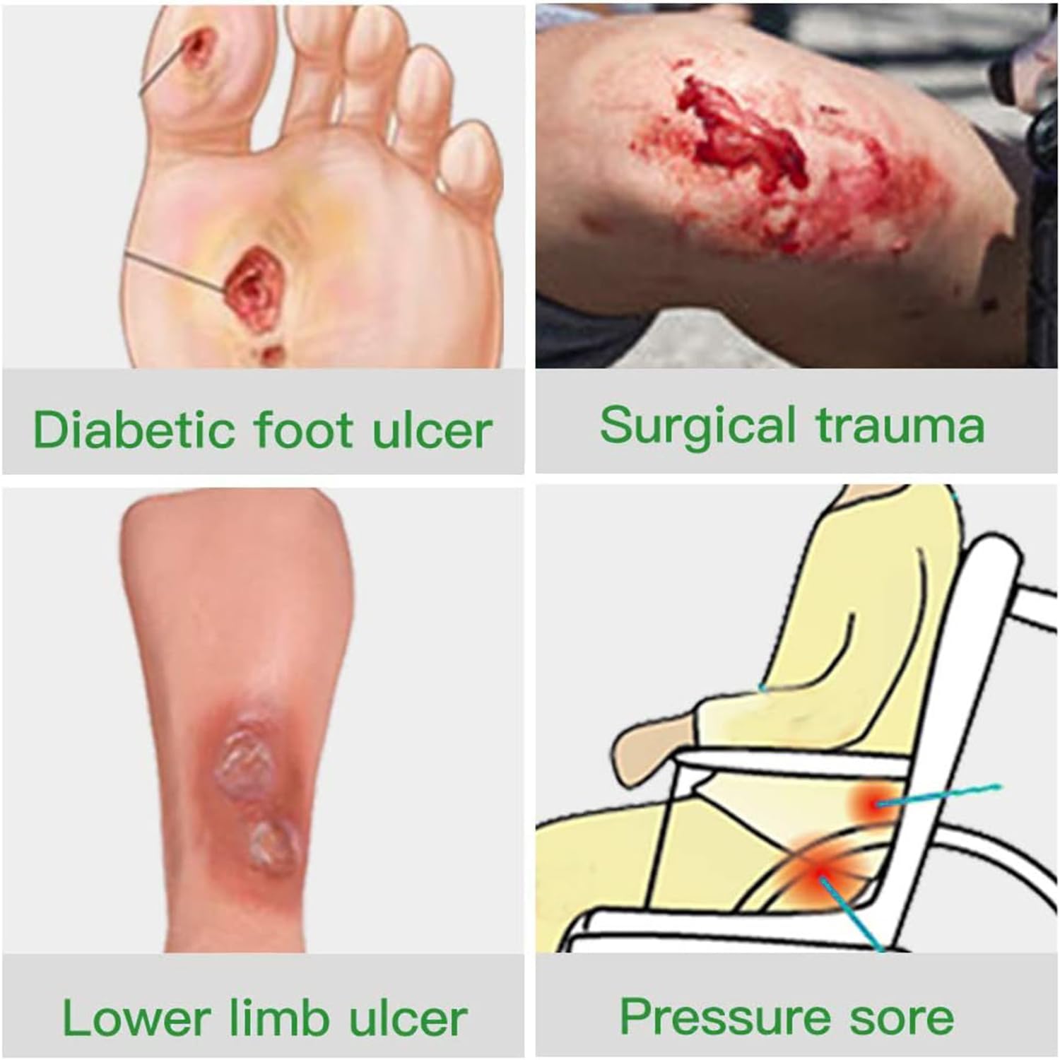 VED Dermapore Adhesive Wound Dressing- Suitable for cuts and grazes, Diabetic Leg ulcers, venous Leg ulcers, Small Pressure sores- Medium, 6 x 7cm (Pack of 50).
